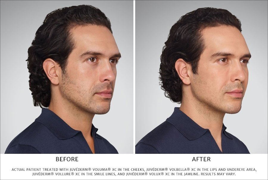 Before and After JUVEDERM cosmetic dermal filler treatment