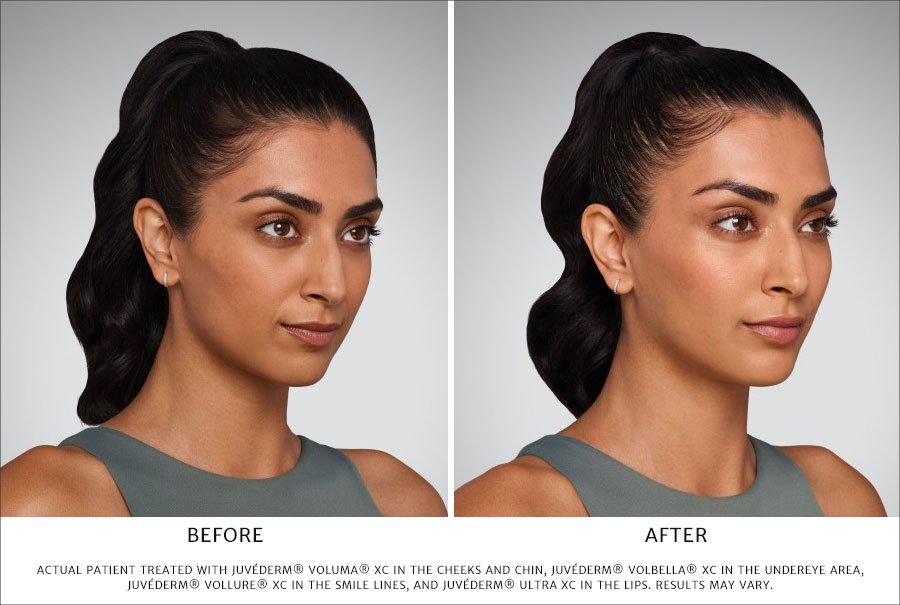 Before and After JUVEDERM cosmetic dermal filler treatment