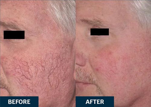 Before and After Candela Vbeam laser treatment