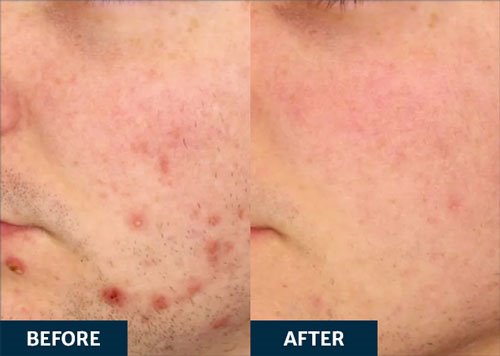 Before and After Candela Vbeam laser treatment